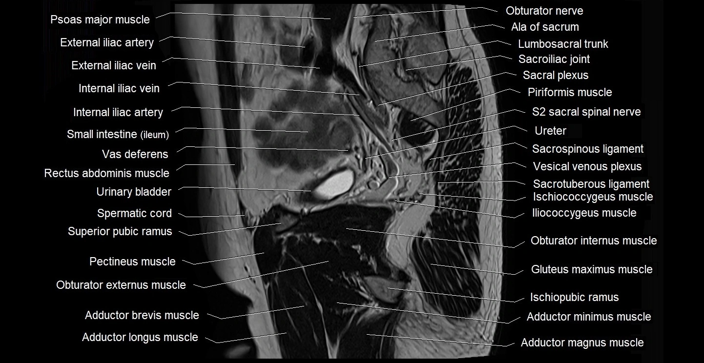 male pelvis sagittal cross sectional anatomy 3T mri image 34.webp